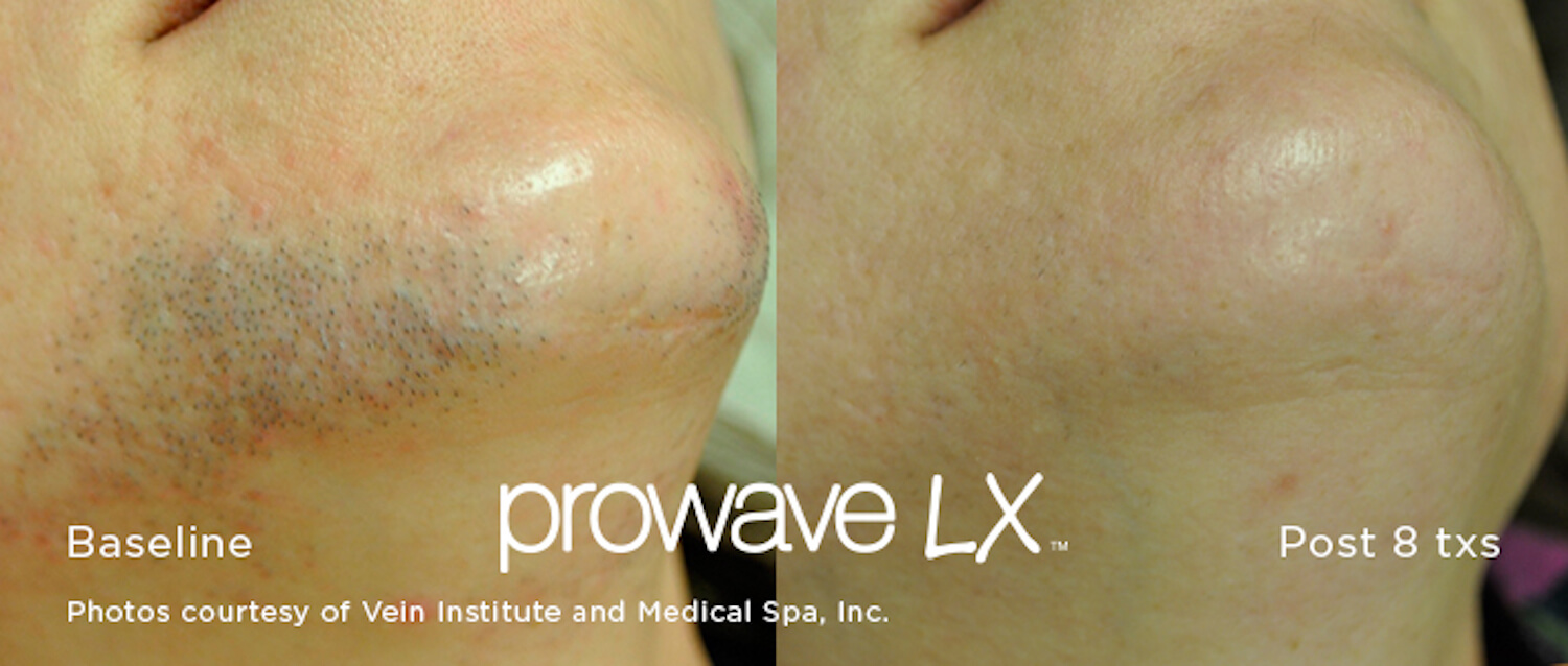 Cutera XEO Prowave LX Before and After