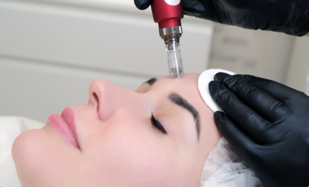 Does Microneedling Hurt What to Expect During the Procedure