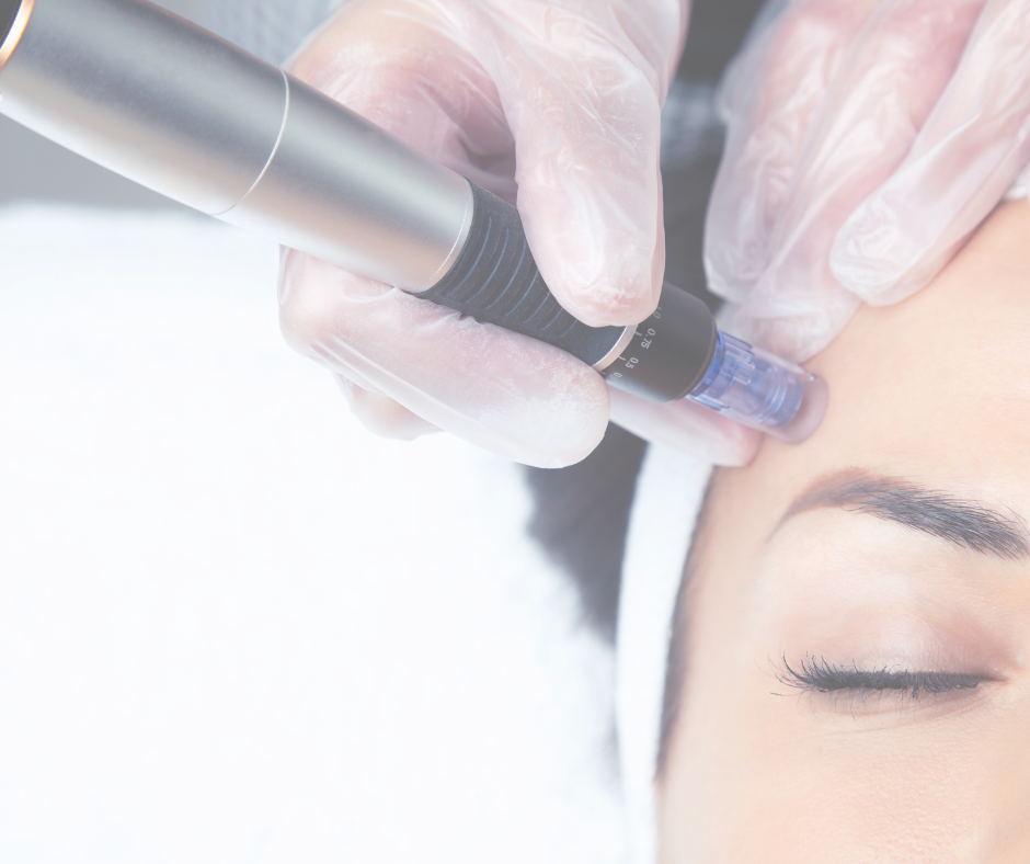 Secret RF radiofrequency microneedling results in Knoxville, TN