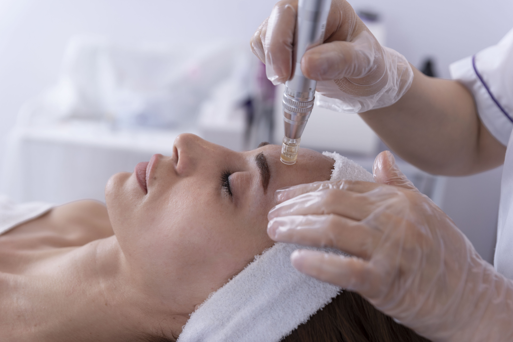 SkinPen microneedling before and after in Maryville, TN