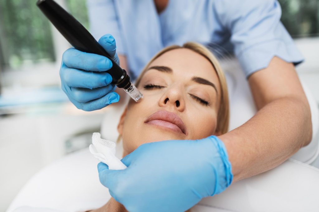 Secret RF microneedling before and after in Knoxville, TN at Skin & Sculpt Med Spa
