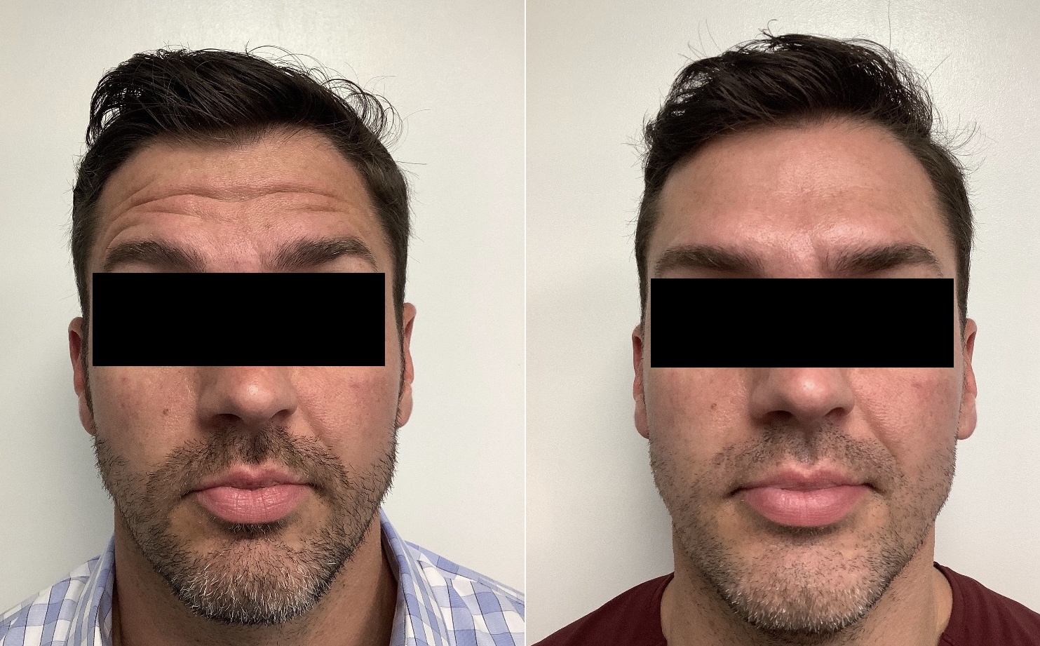 Botox before and after result at Skin & Sculpt Medical Spa