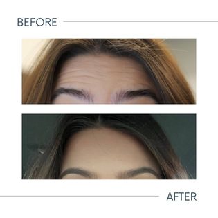Botox before and after photo showing smoother expression lines