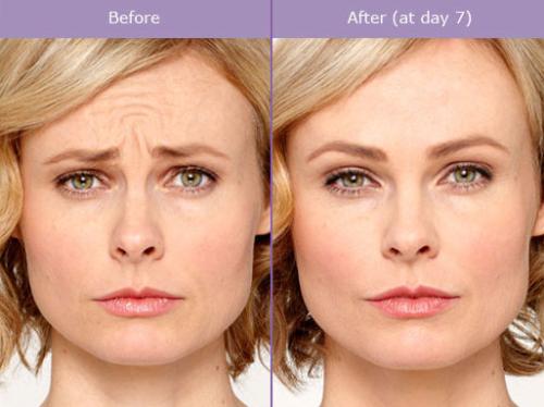 botox-before-after